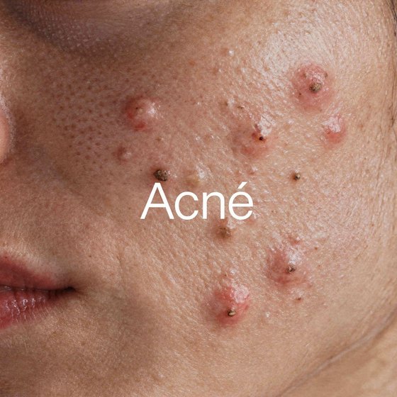 Piel Acn&eacute;