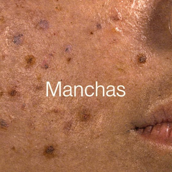 Piel Manchas